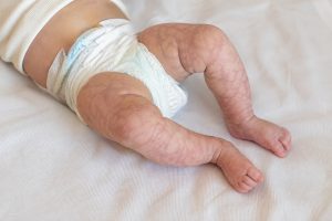 Peau marbrée sur les jambes d’un nourrisson